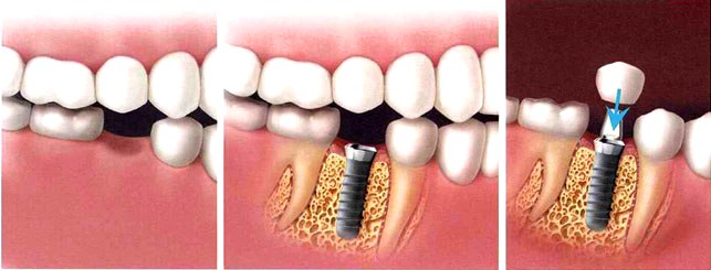 Протезирование зубов на имплантах