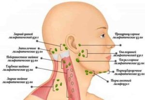 Лимфаденит – статьи о здоровье