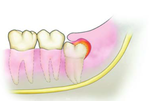 Перикоронит: удаление капюшона зуба мудрости